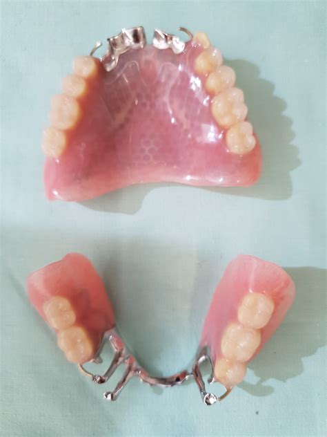 metal housing denture|dentures with metal plate.